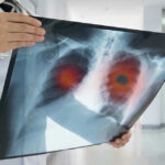 Doctor holding lung X-ray with highlighted areas.